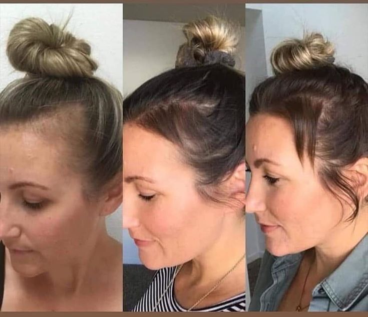 hair loss
