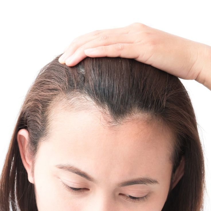 hair loss