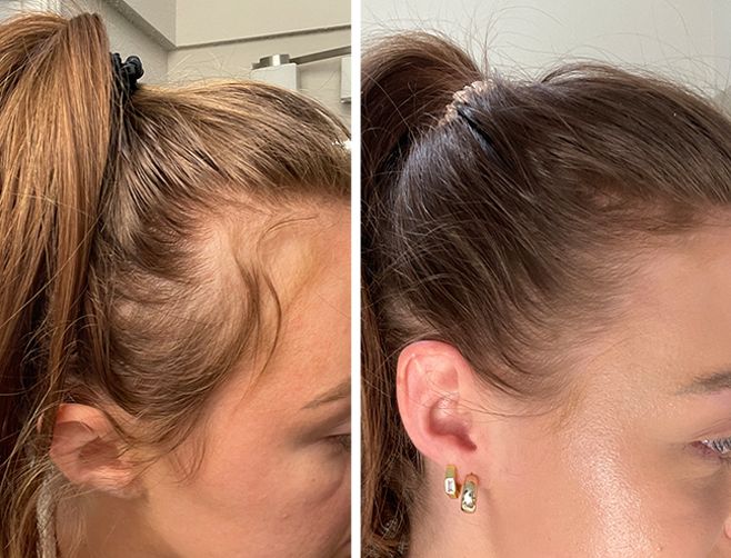 hair loss